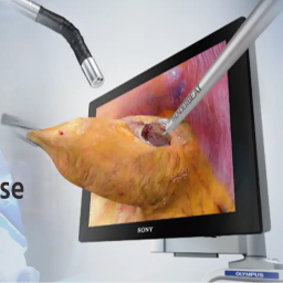 3D Laparoscopy Surgery