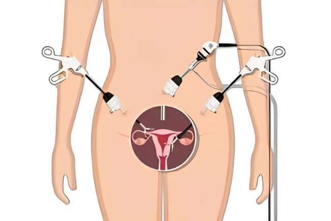 laparoscopic hysterectomy