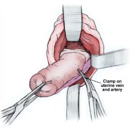 Vaginal Surgery